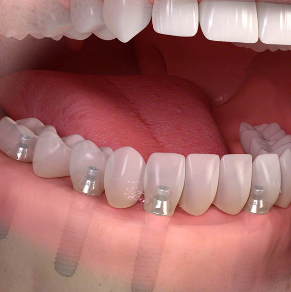 teeth dental implants