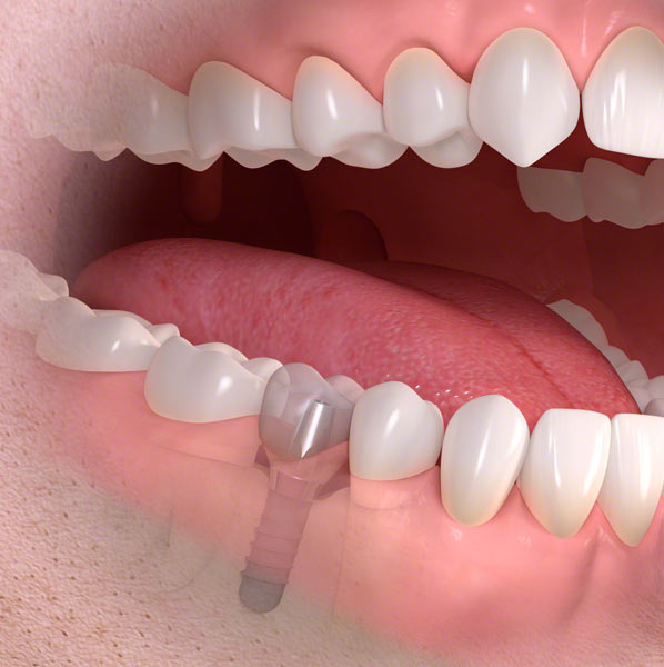 teeth dental implants